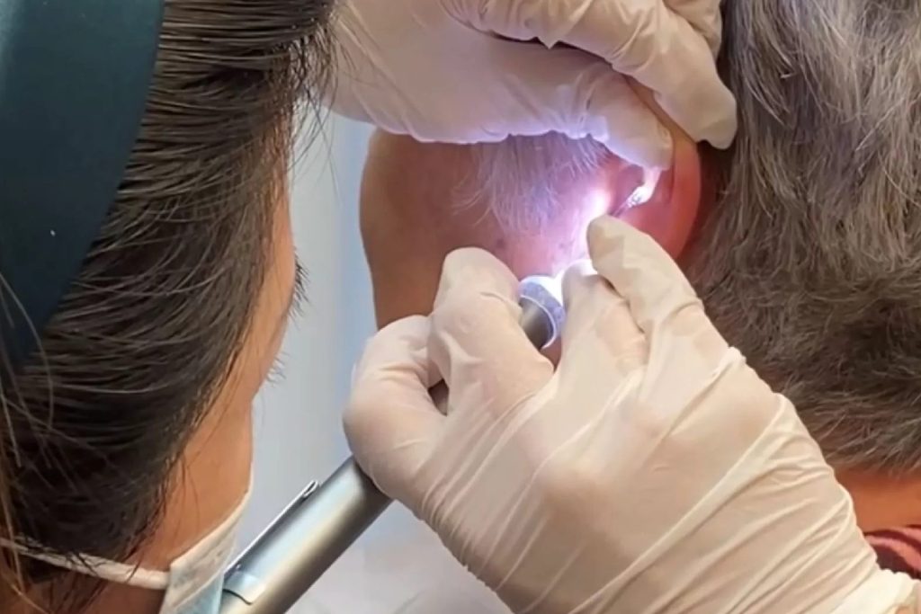 Clinician using gentle micro-suction equipment to clear ear wax from a patient's ear canal at Better Hearing Co.